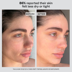Before and after comparison of a person's skin with text indicating improvement.