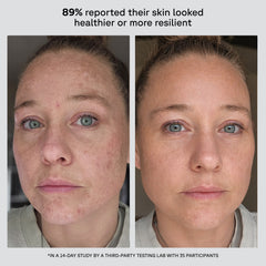 Before and after comparison of a woman's face with text indicating skin health improvement.